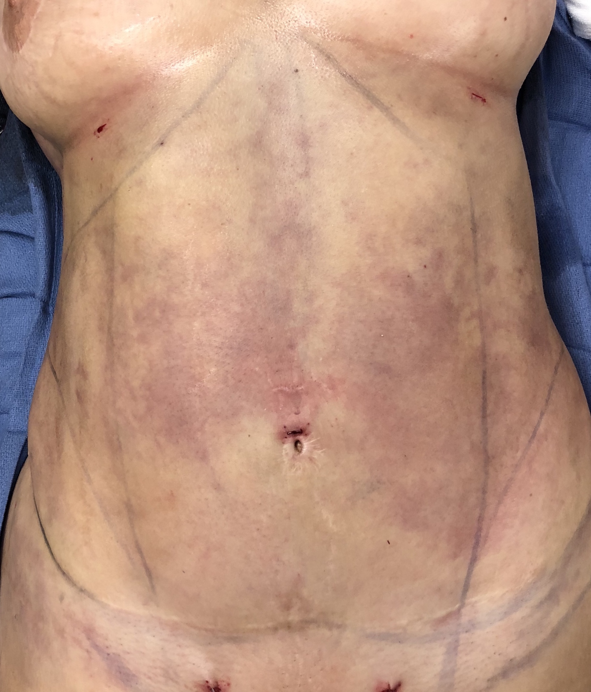 Abdomen Before & After Patient #630