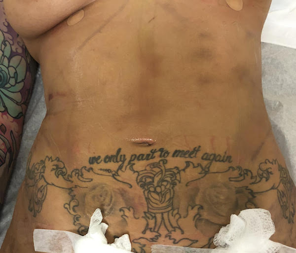 Abdomen Before & After Patient #745