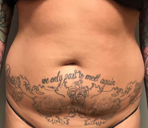 Abdomen Before & After Patient #745