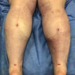 Legs Before & After Patient #739