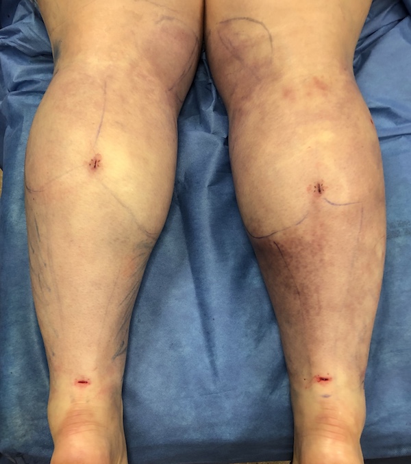 Legs Before & After Patient #739