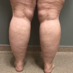 Legs Before & After Patient #739