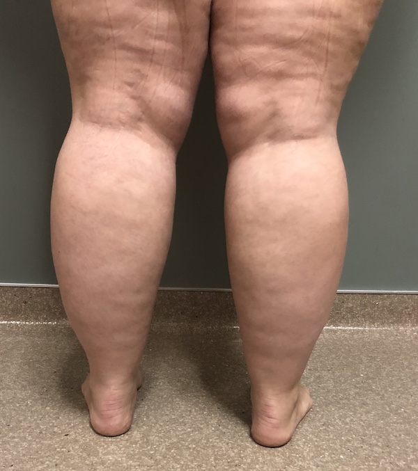 Legs Before & After Patient #739