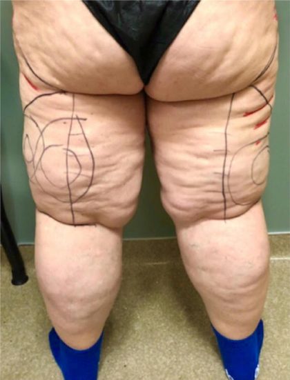 Legs Before & After Patient #748
