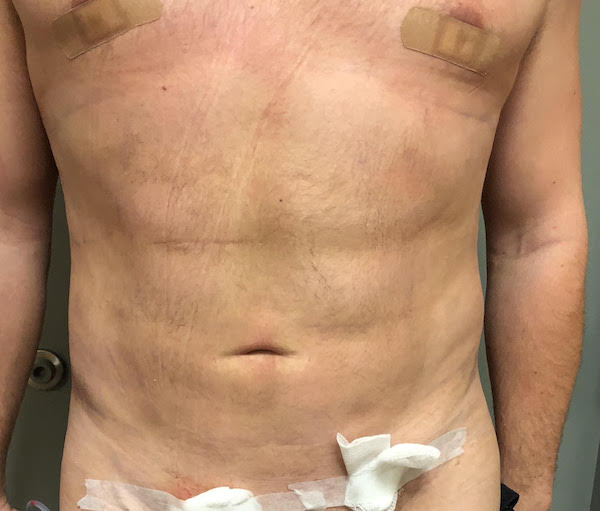 Abdomen Before & After Patient #751