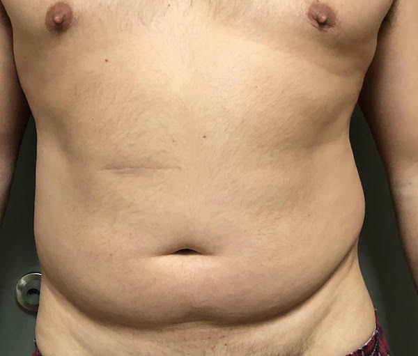 Abdomen Before & After Patient #751