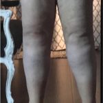 Legs Before & After Patient #748