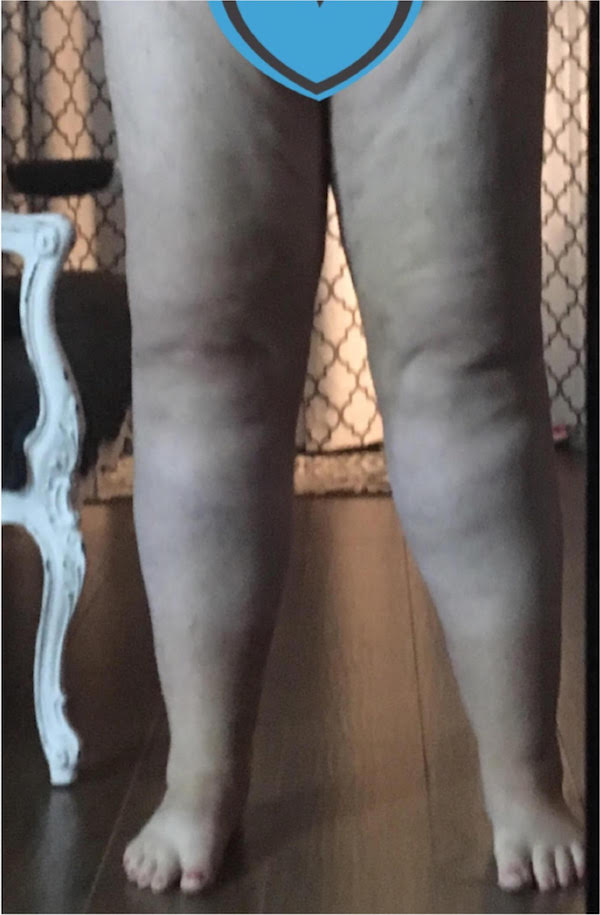 Legs Before & After Patient #748