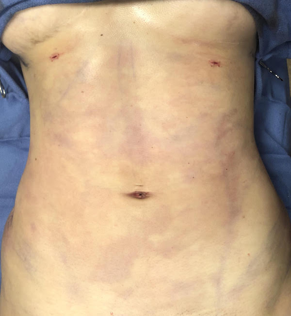 Abdomen Before & After Patient #823