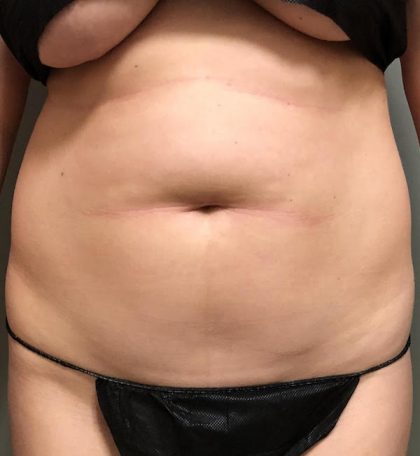 Abdomen Before & After Patient #823