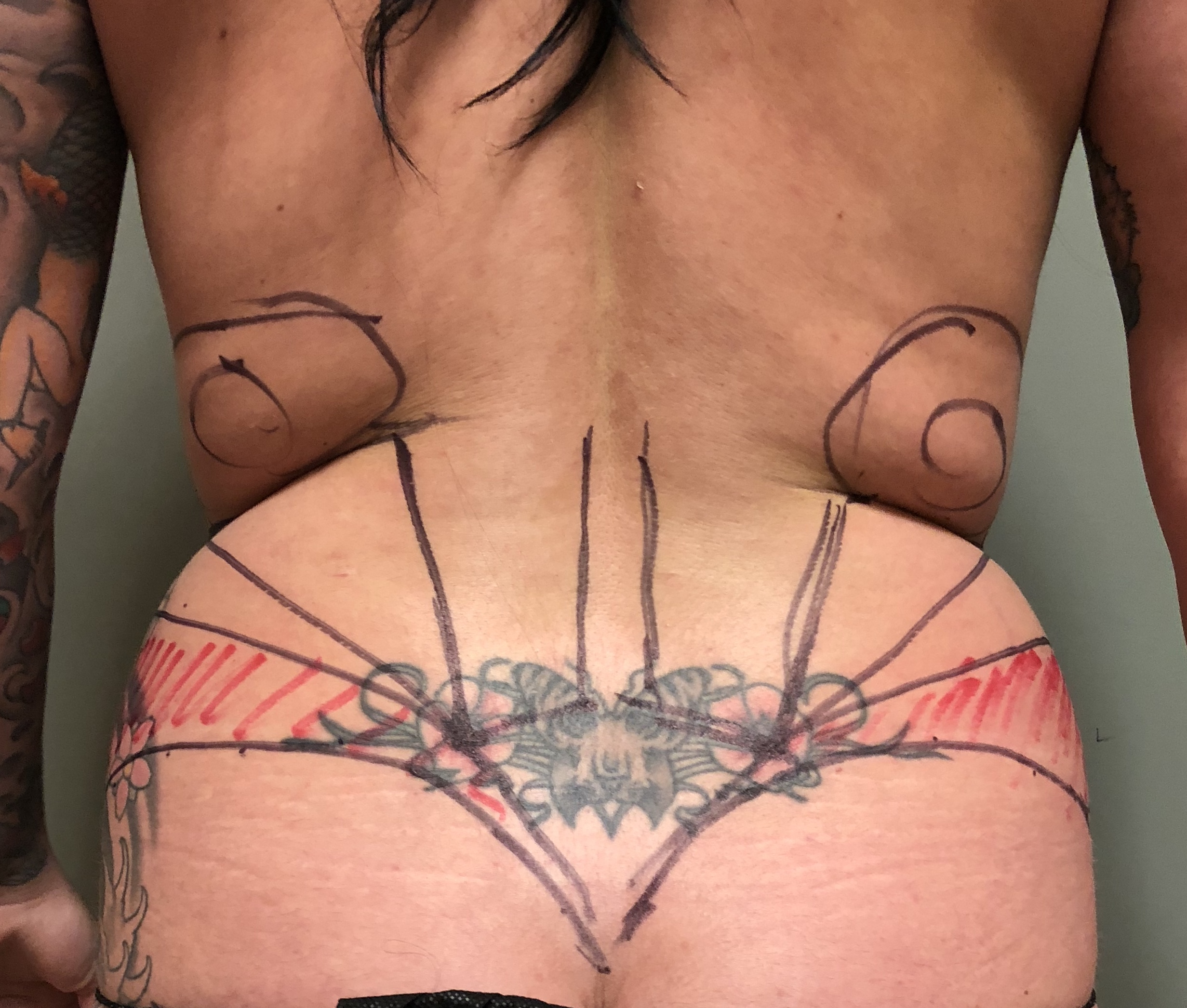 Flanks Before & After Patient #828