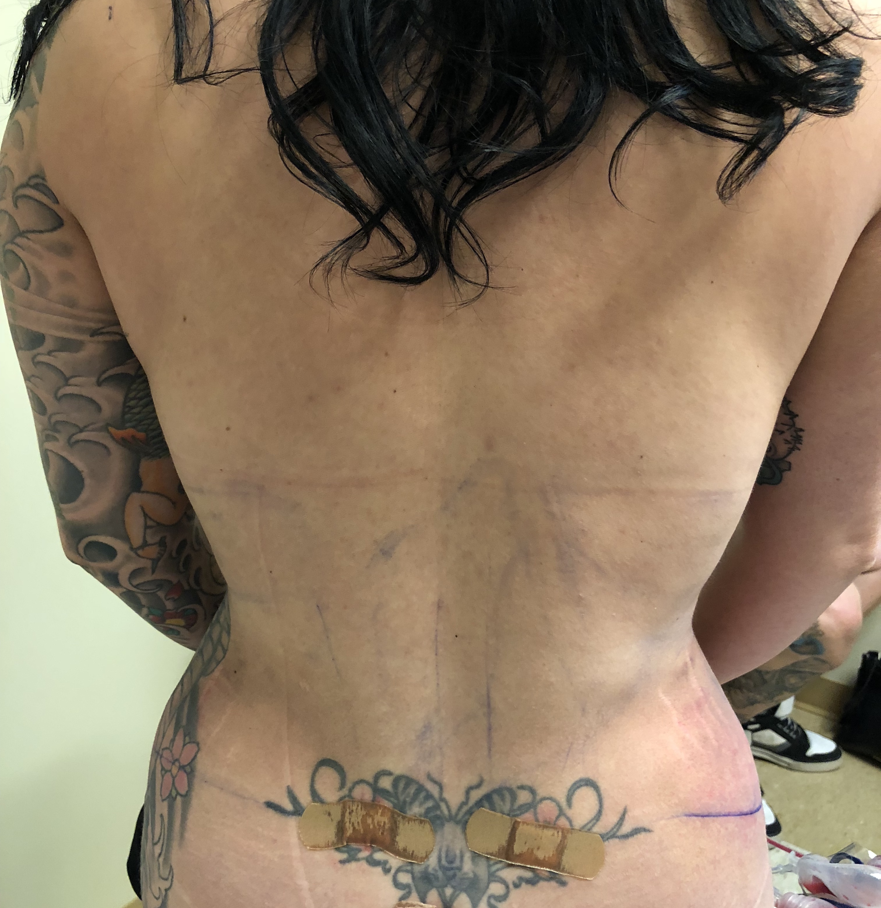 Flanks Before & After Patient #828