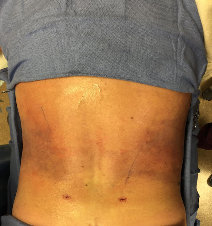 Flanks Before & After Patient #831