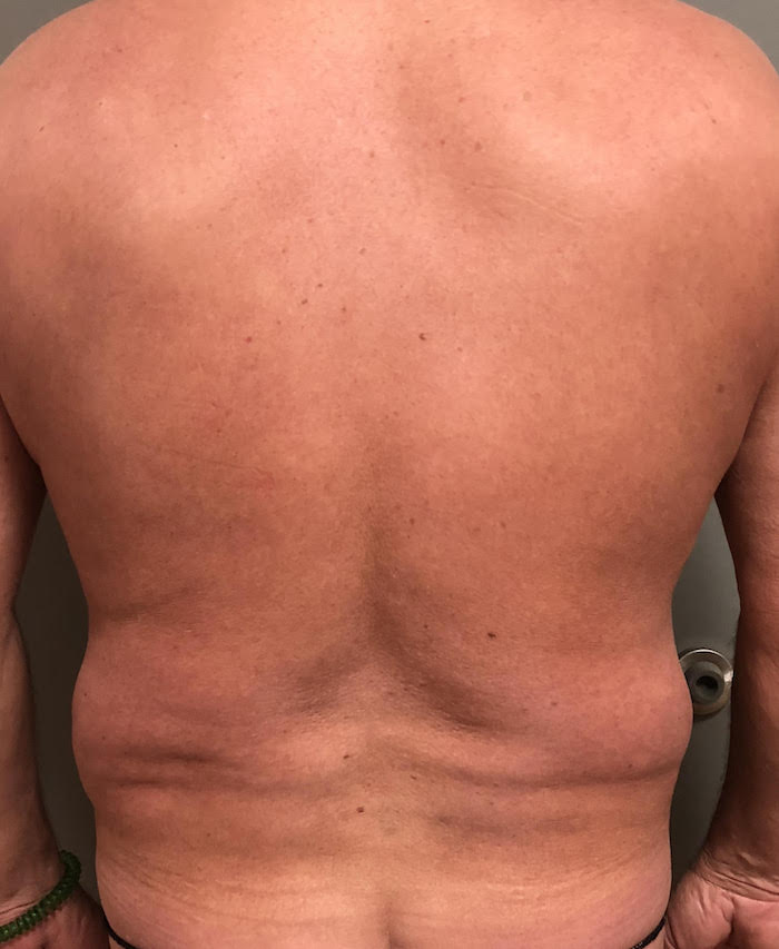 Flanks Before & After Patient #831