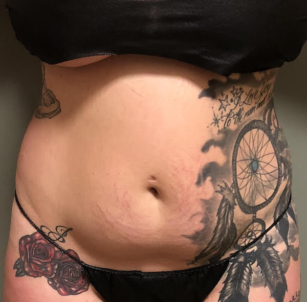 Abdomen Before & After Patient #919