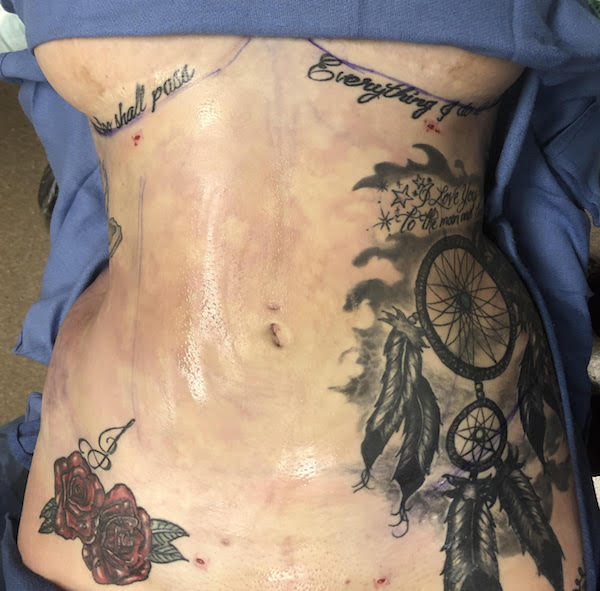 Abdomen Before & After Patient #919