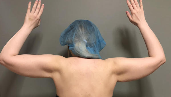 Arms Before & After Patient #922