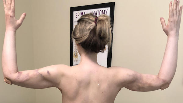 Arms Before & After Patient #922