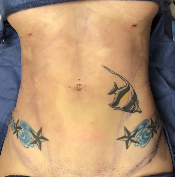 Abdomen Before & After Patient #988