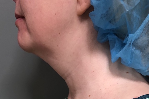 Neck Before & After Patient #1025