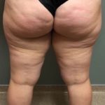Lipedema Before & After Patient #1000