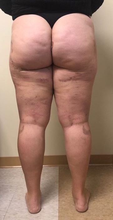 Lipedema Before & After Patient #1000