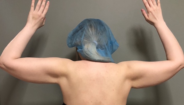 Arms Before & After Patient #1042