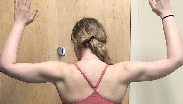Arms Before & After Patient #1042
