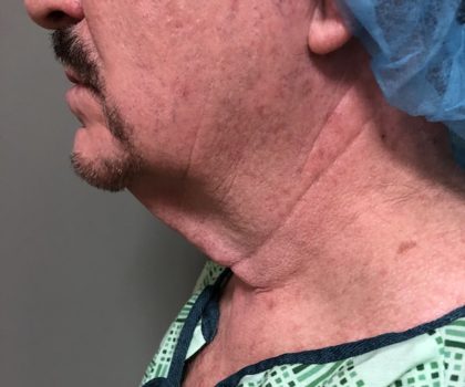 Neck Before & After Patient #994