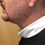 Neck Before & After Patient #994