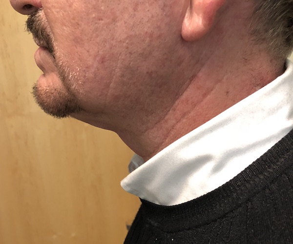 Neck Before & After Patient #994