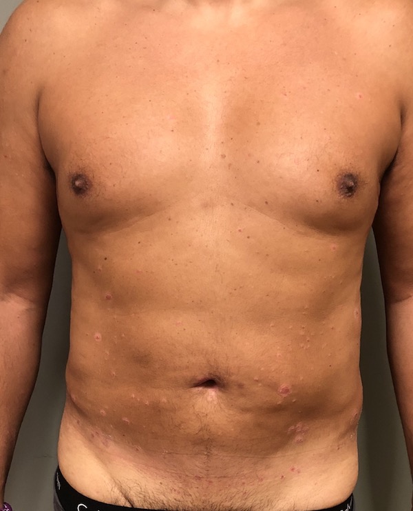 Abdomen Before & After Patient #997