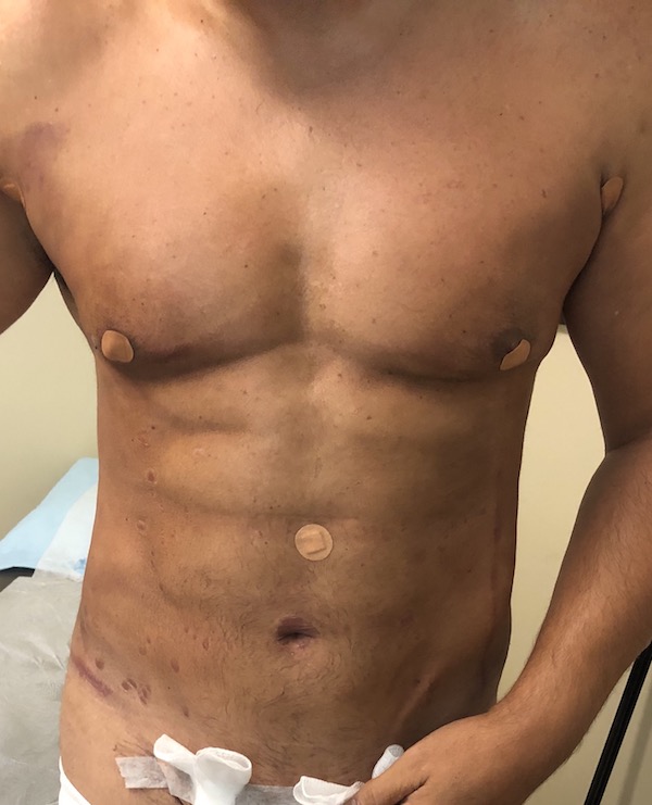 Abdomen Before & After Patient #997
