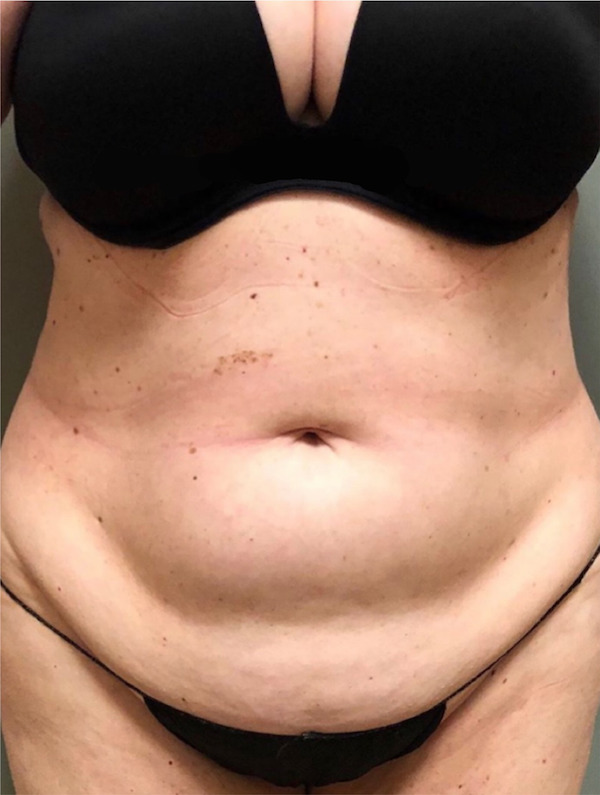 Abdomen Before & After Patient #1008