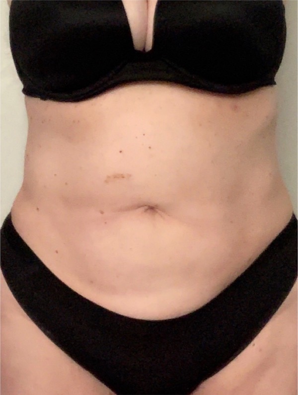 Abdomen Before & After Patient #1008