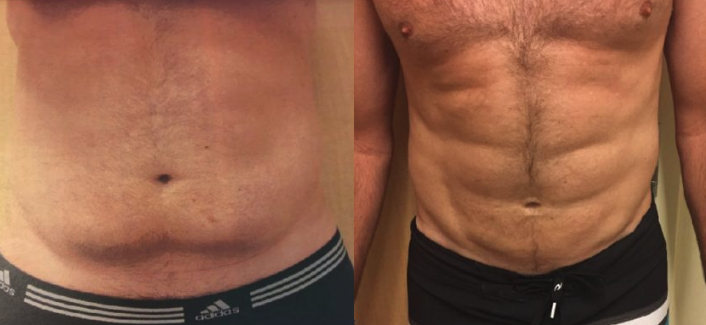 VASER Hi-Def Liposuction Sacramento