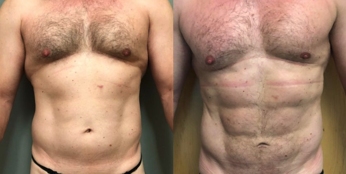 Abdomen & Flanks VASER Liposuction Sacramento