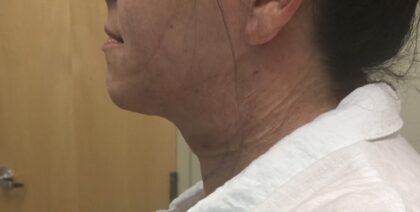 Neck Before & After Patient #1173