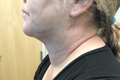 Neck Before & After Patient #1170