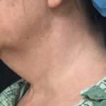 Neck Before & After Patient #1173