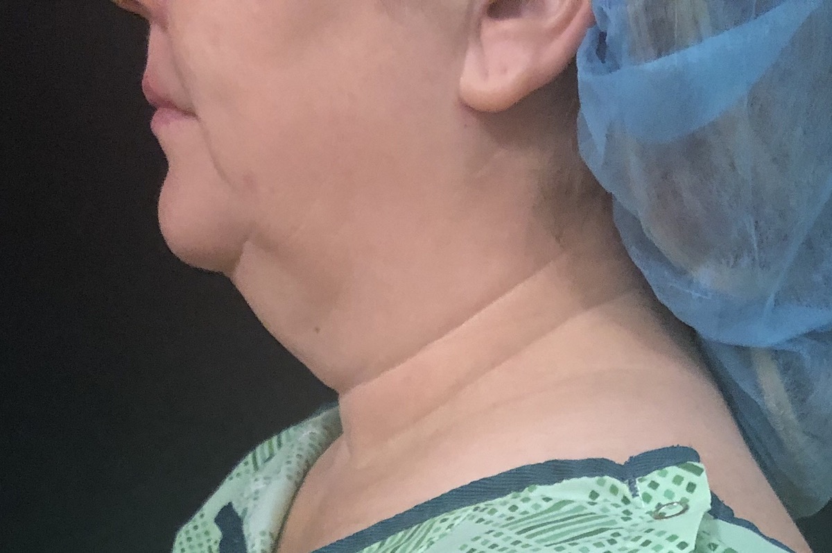 Neck Before & After Patient #1170