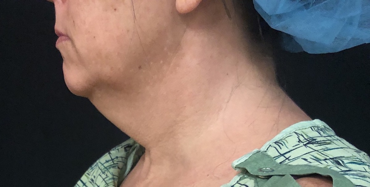 Neck Before & After Patient #1173