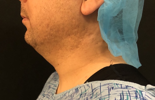 Neck Before & After Patient #1187