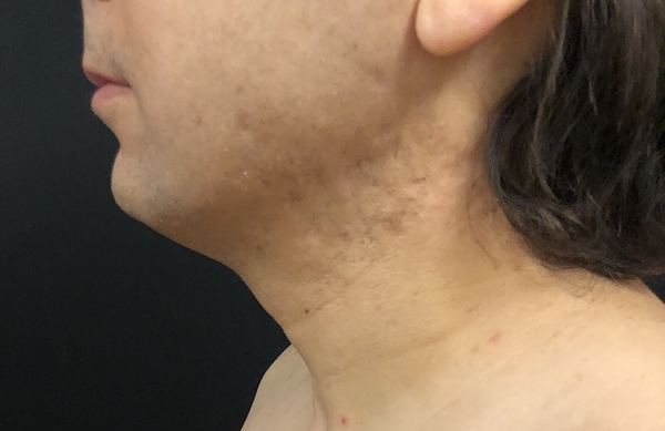 Neck Before & After Patient #1187