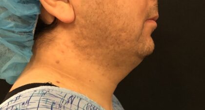 Neck Before & After Patient #1187