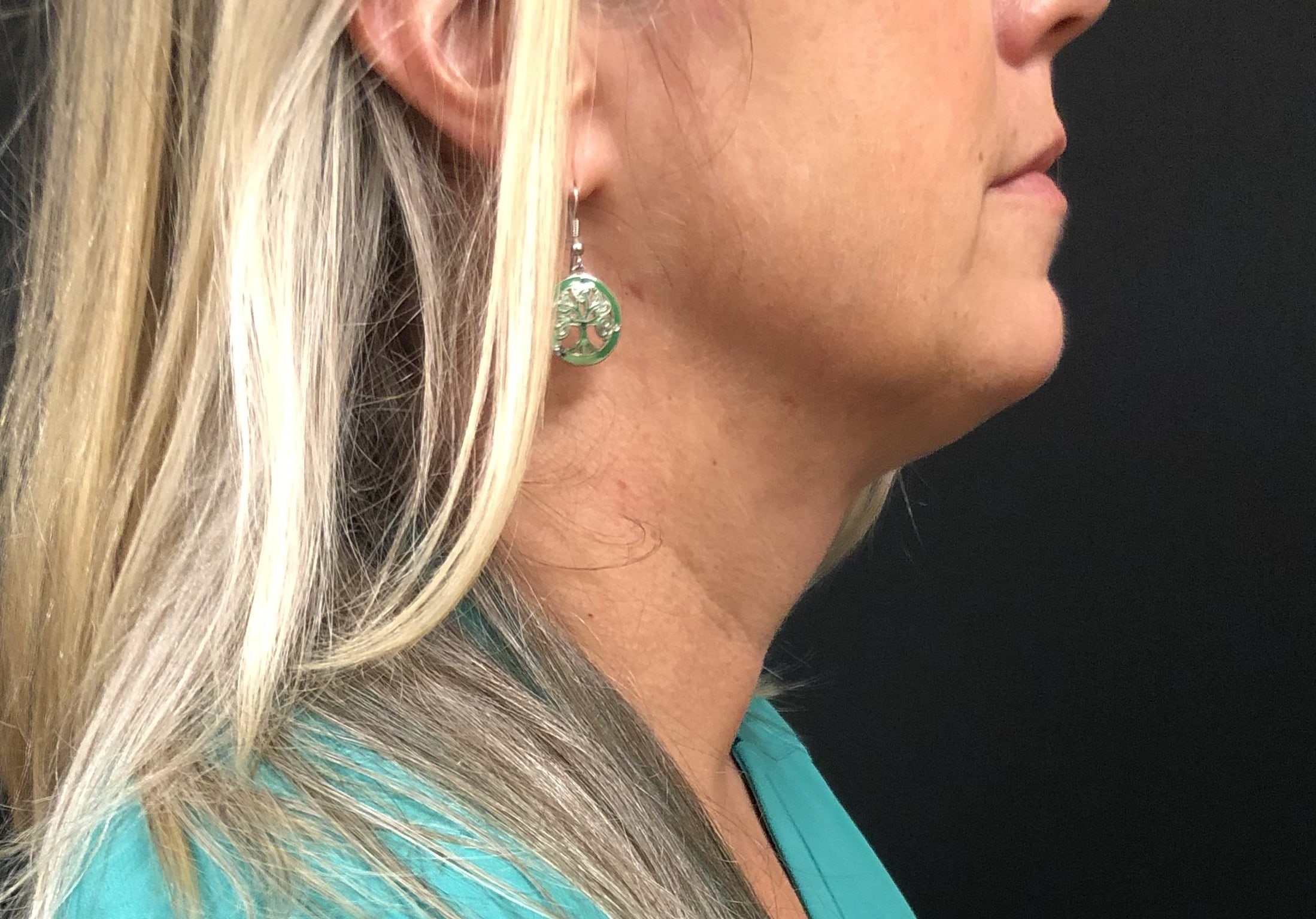 Neck Before & After Patient #1279