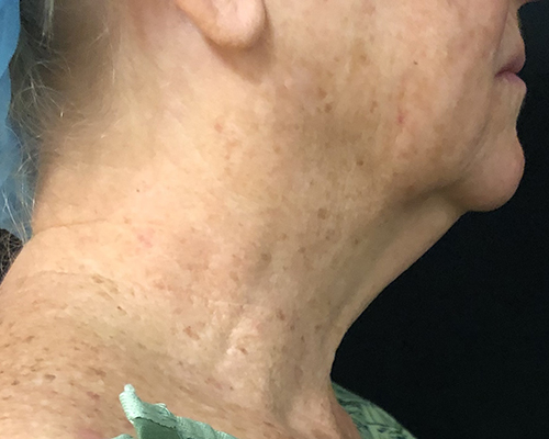 Neck Before & After Patient #1274