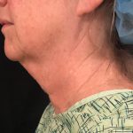 Neck Before & After Patient #1282