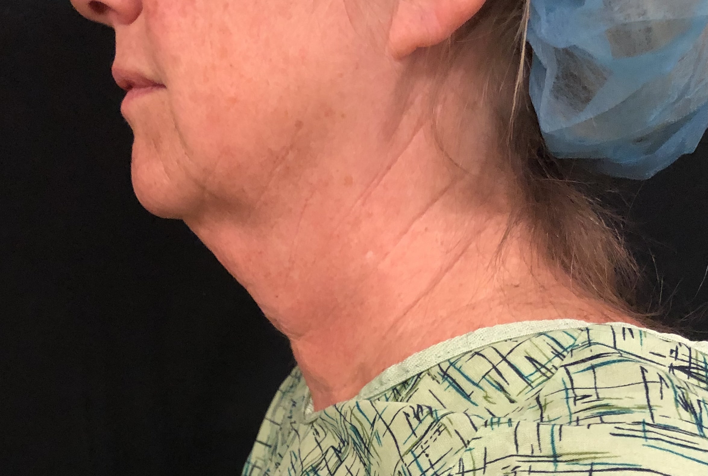 Neck Before & After Patient #1282