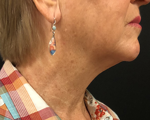 Neck Before & After Patient #1274